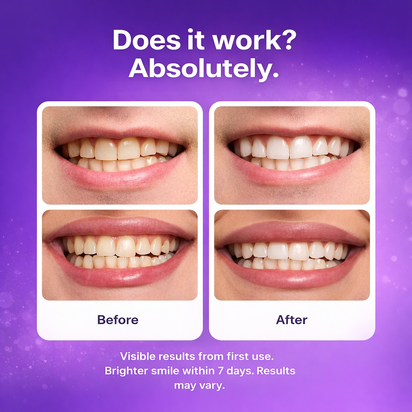 LumeoBay™ Purple Whitening Strips – At-Home Teeth Brightening